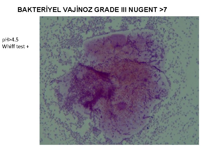 BAKTERİYEL VAJİNOZ GRADE III NUGENT >7 p. H>4. 5 Whiff test + 