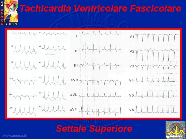 Tachicardia Ventricolare Fascicolare Settale Superiore ep_lab@lecce. it 