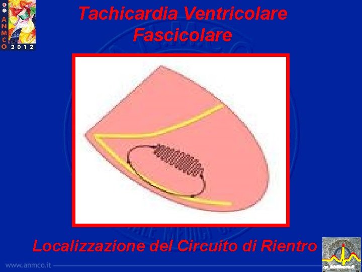 Tachicardia Ventricolare Fascicolare Localizzazione del Circuito di Rientro ep_lab@lecce. it 