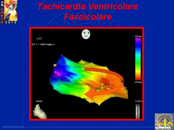 Tachicardia Ventricolare Fascicolare ep_lab@lecce. it 