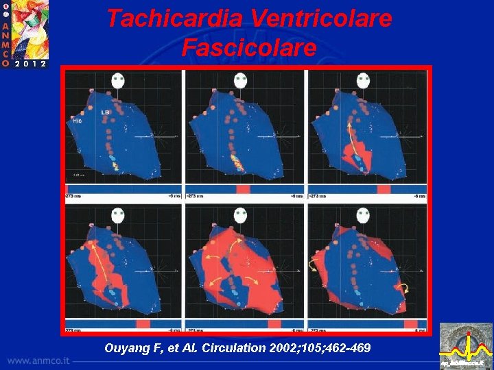 Tachicardia Ventricolare Fascicolare Ouyang F, et Al. Circulation 2002; 105; 462 -469 ep_lab@lecce. it