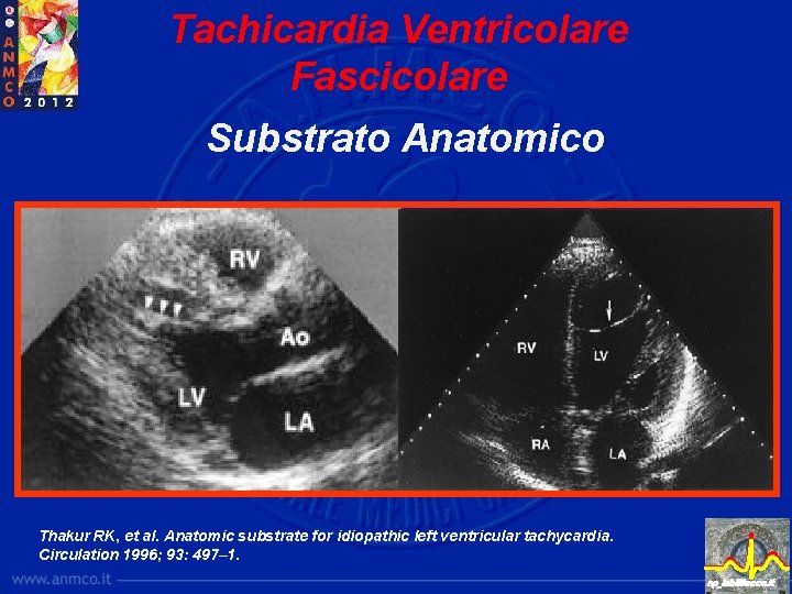 Tachicardia Ventricolare Fascicolare Substrato Anatomico Thakur RK, et al. Anatomic substrate for idiopathic left