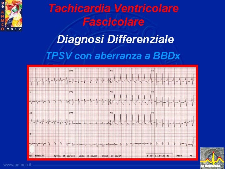 Tachicardia Ventricolare Fascicolare Diagnosi Differenziale TPSV con aberranza a BBDx ep_lab@lecce. it 
