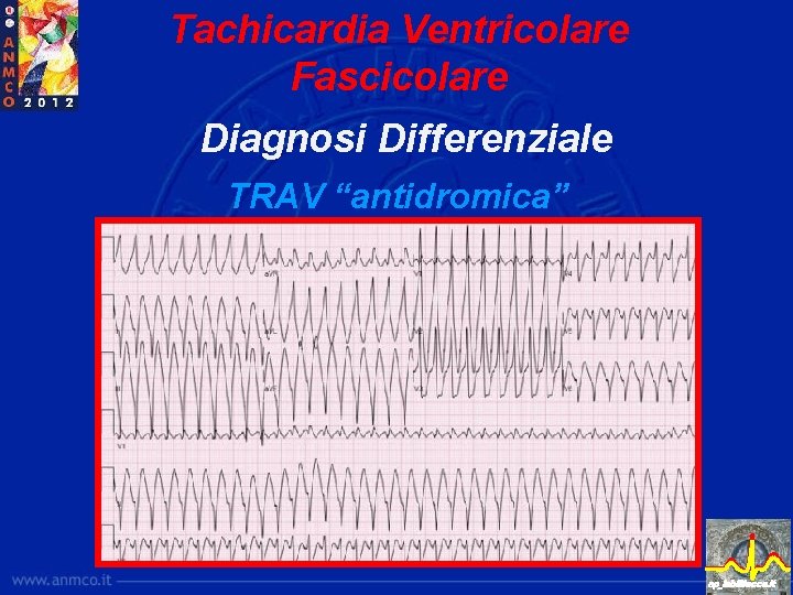 Tachicardia Ventricolare Fascicolare Diagnosi Differenziale TRAV “antidromica” ep_lab@lecce. it 