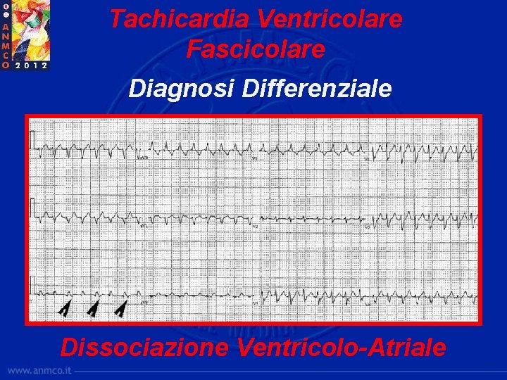 Tachicardia Ventricolare Fascicolare Diagnosi Differenziale Dissociazione Ventricolo-Atriale 