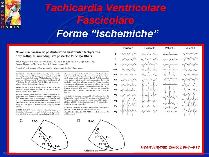 Tachicardia Ventricolare Fascicolare Forme “ischemiche” (Heart Rhythm 2006; 3: 908 – 918 