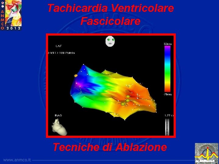 Tachicardia Ventricolare Fascicolare Tecniche di Ablazione ep_lab@lecce. it 