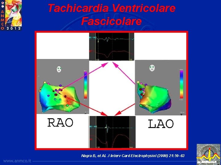 Tachicardia Ventricolare Fascicolare Nagra B, et Al. J Interv Card Electrophysiol (2008) 21: 59–