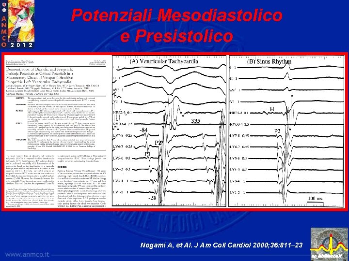 Potenziali Mesodiastolico e Presistolico Nogami A, et Al. J Am Coll Cardiol 2000; 36: