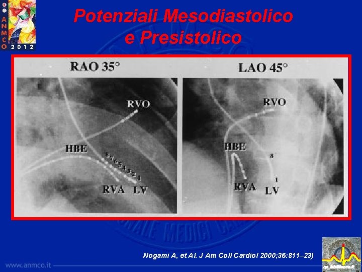 Potenziali Mesodiastolico e Presistolico Nogami A, et Al. J Am Coll Cardiol 2000; 36: