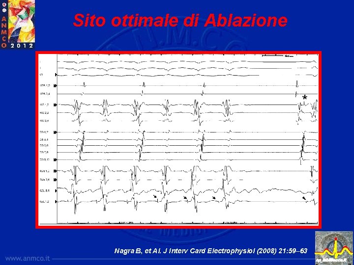 Sito ottimale di Ablazione Nagra B, et Al. J Interv Card Electrophysiol (2008) 21: