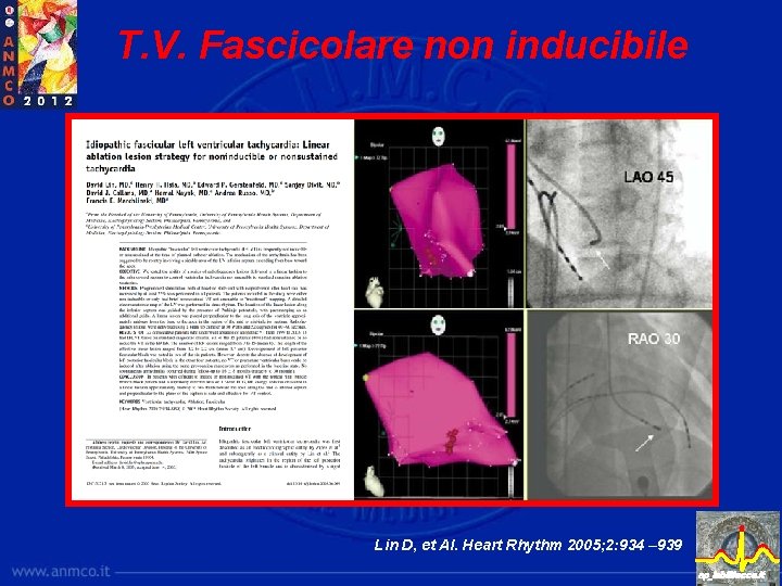 T. V. Fascicolare non inducibile Lin D, et Al. Heart Rhythm 2005; 2: 934