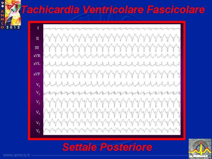 Tachicardia Ventricolare Fascicolare Settale Posteriore ep_lab@lecce. it 