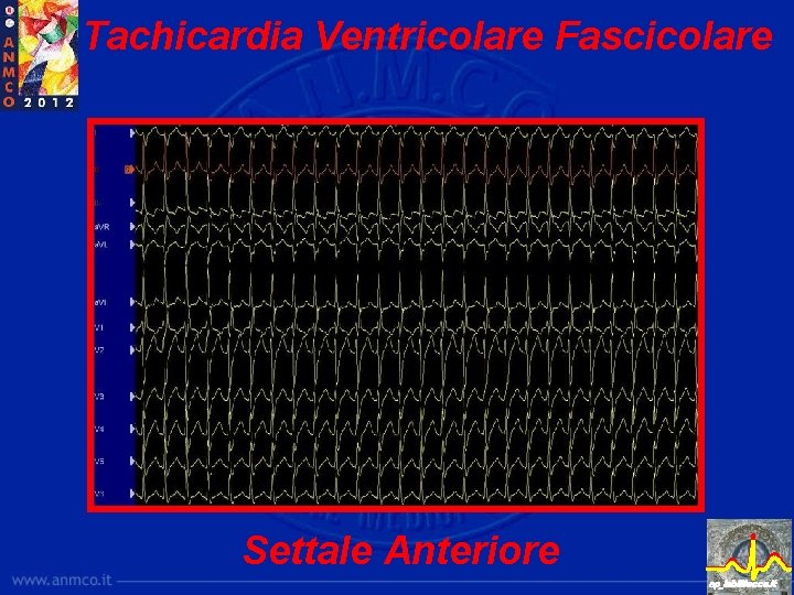 Tachicardia Ventricolare Fascicolare Settale Anteriore ep_lab@lecce. it 