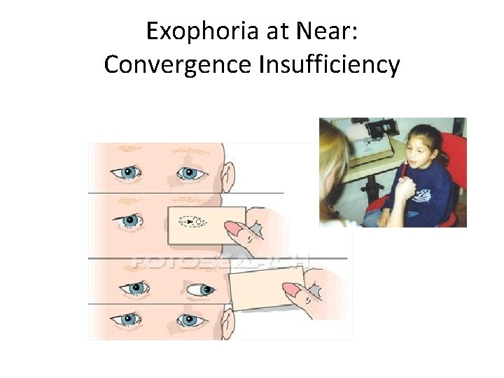 Exophoria at Near: Convergence Insufficiency 