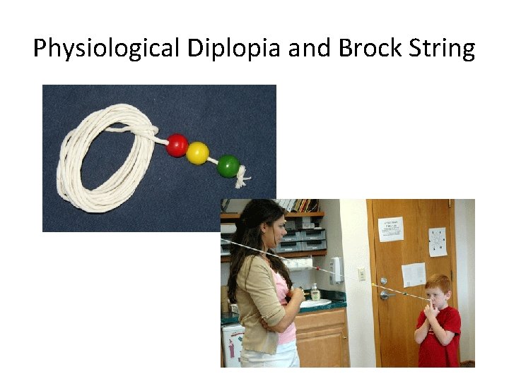 Physiological Diplopia and Brock String 