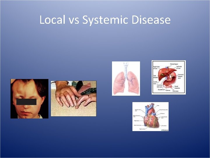 Local vs Systemic Disease 