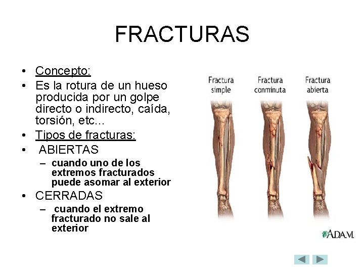 FRACTURAS • Concepto: • Es la rotura de un hueso producida por un golpe