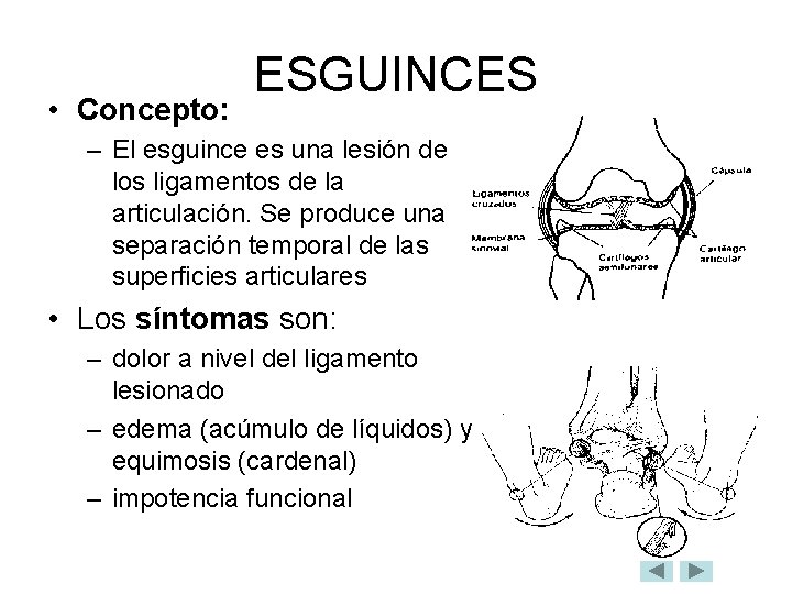  • Concepto: ESGUINCES – El esguince es una lesión de los ligamentos de