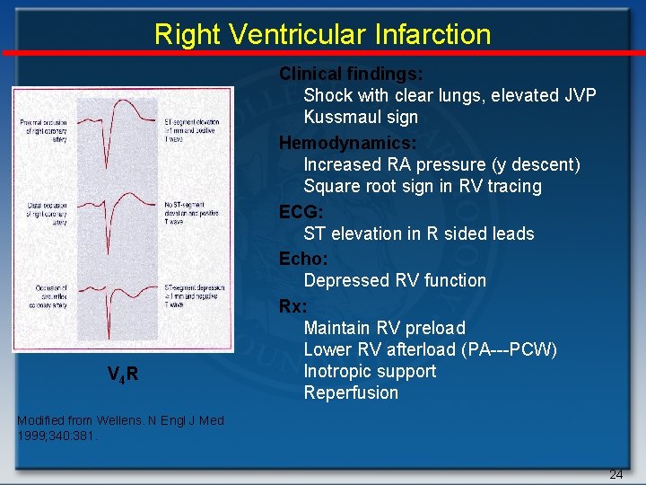 Right Ventricular Infarction V 4 R Clinical findings: Shock with clear lungs, elevated JVP