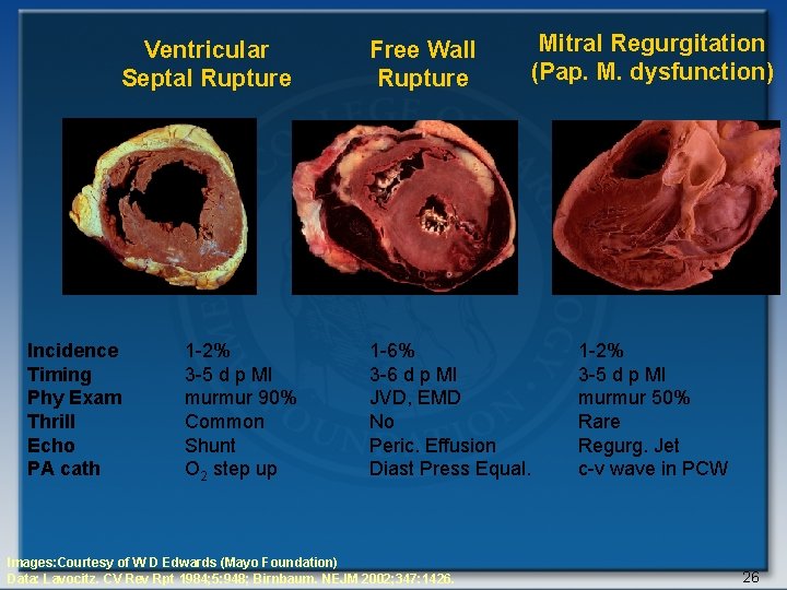 Ventricular Septal Rupture Incidence Timing Phy Exam Thrill Echo PA cath 1 -2% 3