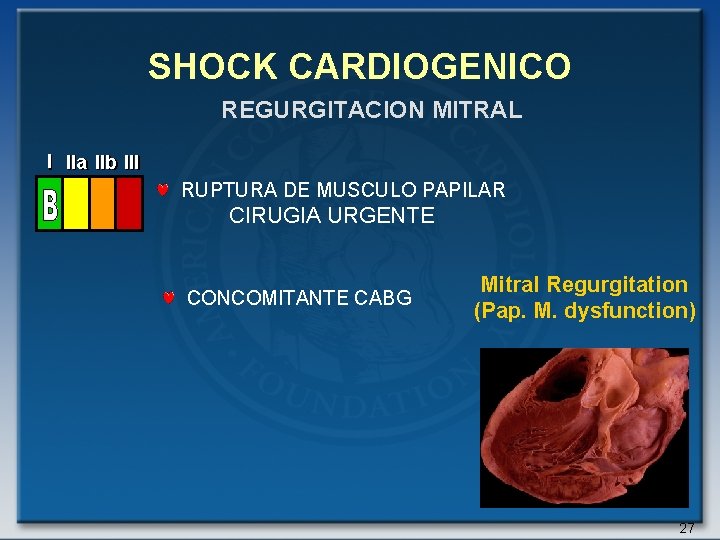 SHOCK CARDIOGENICO REGURGITACION MITRAL I IIa IIb III RUPTURA DE MUSCULO PAPILAR CIRUGIA URGENTE