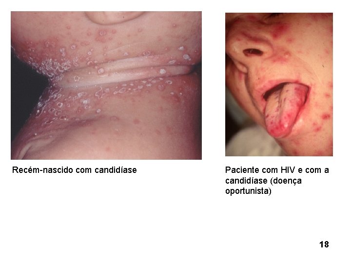 Recém-nascido com candidíase Paciente com HIV e com a candidíase (doença oportunista) 18 