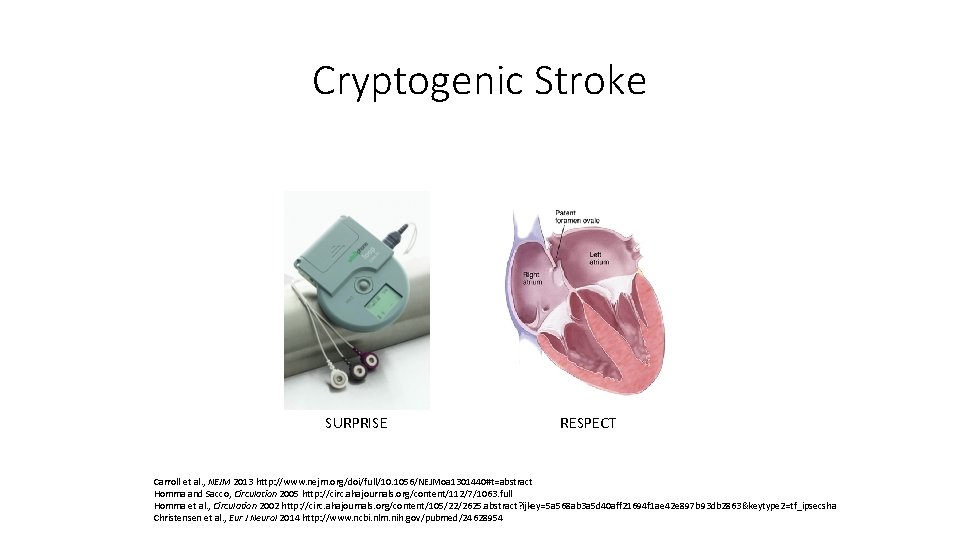 Cryptogenic Stroke SURPRISE RESPECT Carroll et al. , NEJM 2013 http: //www. nejm. org/doi/full/10.