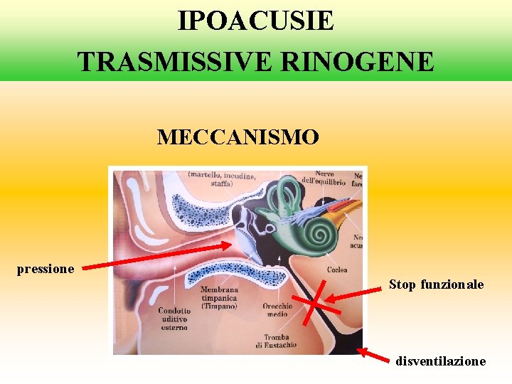 IPOACUSIE TRASMISSIVE RINOGENE MECCANISMO pressione Stop funzionale disventilazione 