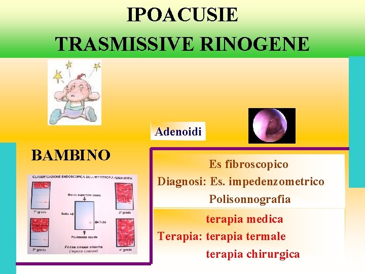 IPOACUSIE TRASMISSIVE RINOGENE Adenoidi BAMBINO Es fibroscopico Diagnosi: Es. impedenzometrico Polisonnografia terapia medica Terapia: