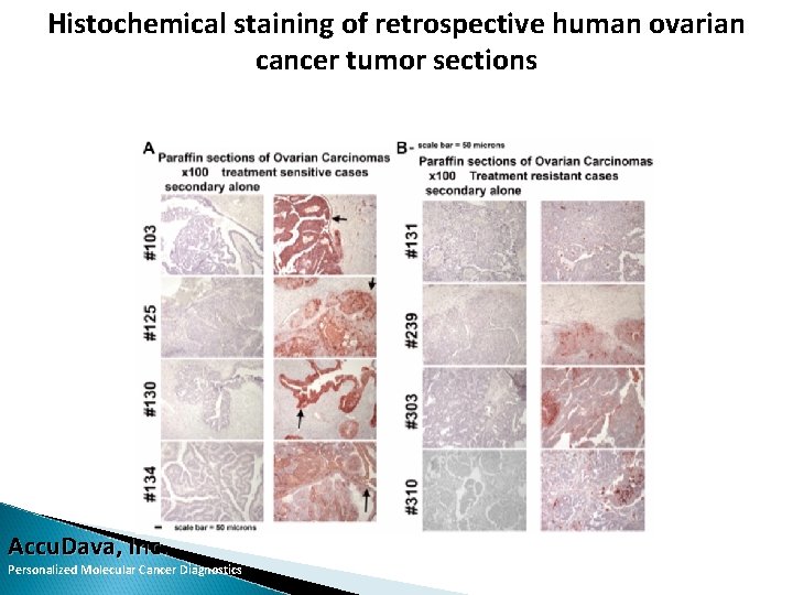 Histochemical staining of retrospective human ovarian cancer tumor sections Accu. Dava, Inc. Personalized Molecular