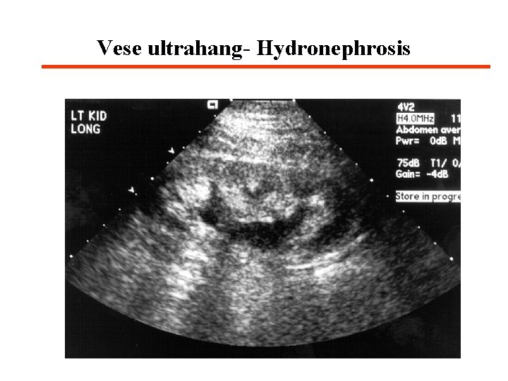 Vese ultrahang- Hydronephrosis 
