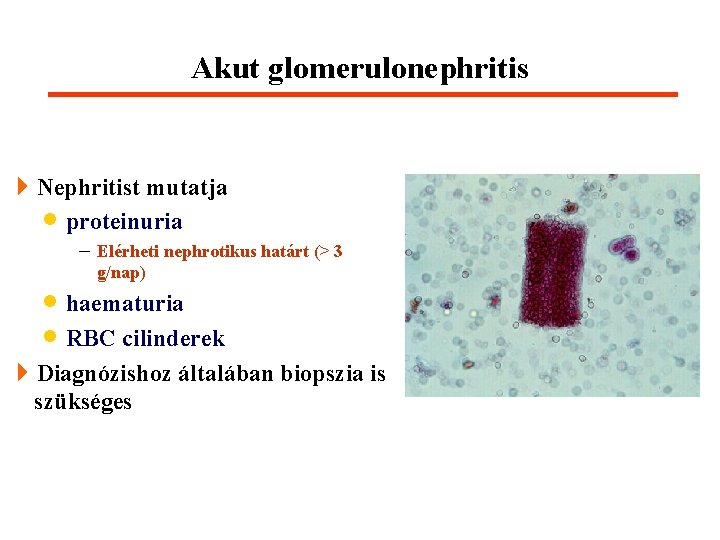 Akut glomerulonephritis 4 Nephritist mutatja · proteinuria - Elérheti nephrotikus határt (> 3 g/nap)