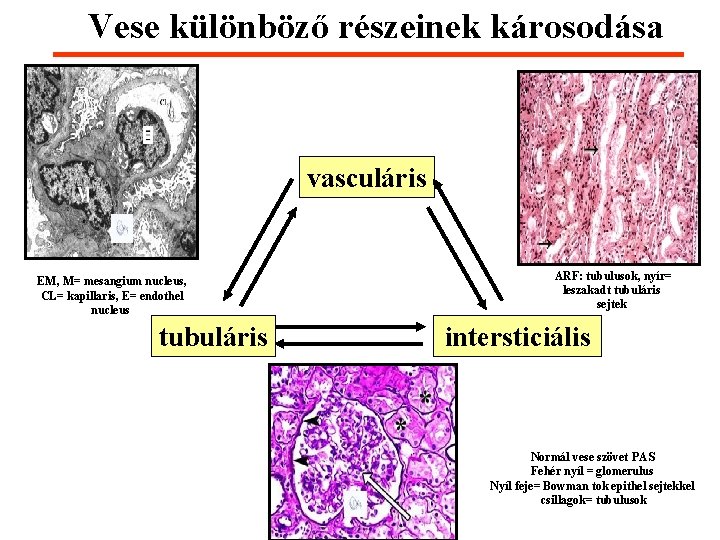 Vese különböző részeinek károsodása vasculáris EM, M= mesangium nucleus, CL= kapillaris, E= endothel nucleus