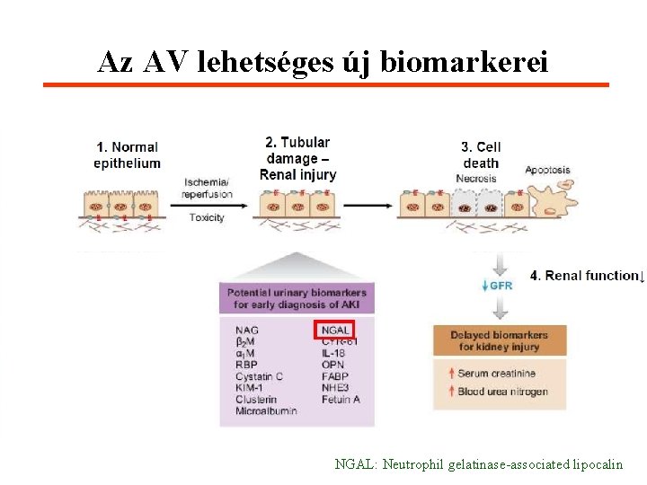 Az AV lehetséges új biomarkerei NGAL: Neutrophil gelatinase-associated lipocalin 