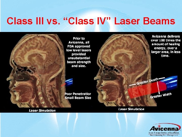 Class III vs. “Class IV” Laser Beams 