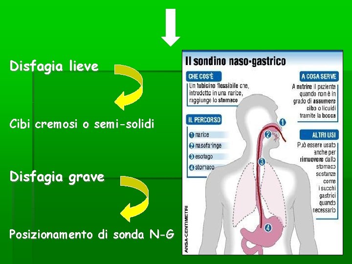 Disfagia lieve Cibi cremosi o semi-solidi Disfagia grave Posizionamento di sonda N-G Disfagia lieve Cibi cremosi o semi-solidi Disfagia grave Posizionamento di sonda N-G