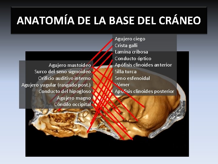 ANATOMÍA DE LA BASE DEL CRÁNEO Agujero mastoideo Surco del seno sigmoideo Orificio auditivo