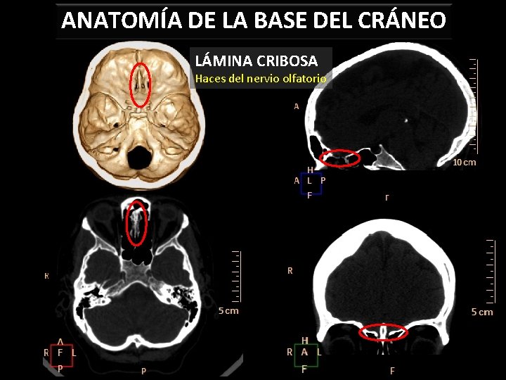 ANATOMÍA DE LA BASE DEL CRÁNEO LÁMINA CRIBOSA Haces del nervio olfatorio 