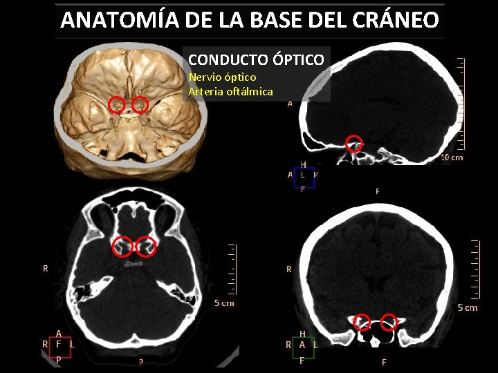 ANATOMÍA DE LA BASE DEL CRÁNEO CONDUCTO ÓPTICO Nervio óptico Arteria oftálmica 