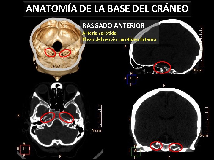 ANATOMÍA DE LA BASE DEL CRÁNEO RASGADO ANTERIOR Arteria carótida Plexo del nervio carotideo