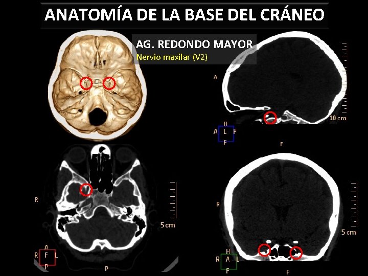 ANATOMÍA DE LA BASE DEL CRÁNEO AG. REDONDO MAYOR Nervio maxilar (V 2) 