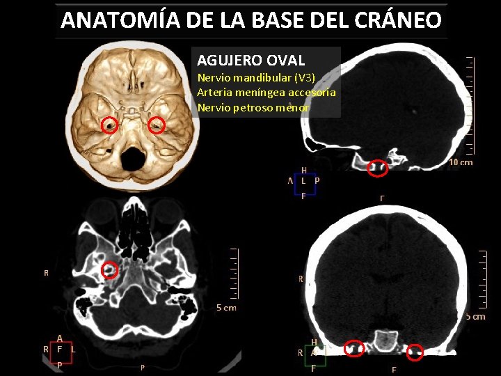 ANATOMÍA DE LA BASE DEL CRÁNEO AGUJERO OVAL Nervio mandibular (V 3) Arteria meníngea