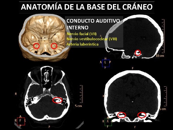 ANATOMÍA DE LA BASE DEL CRÁNEO CONDUCTO AUDITIVO INTERNO Nervio facial (VII) Nervio vestíbulococlear