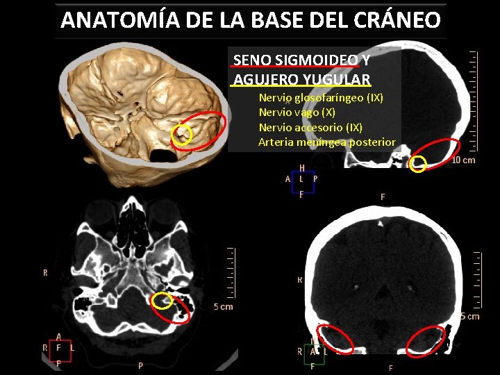 ANATOMÍA DE LA BASE DEL CRÁNEO SENO SIGMOIDEO Y AGUJERO YUGULAR Nervio glosofaríngeo (IX)