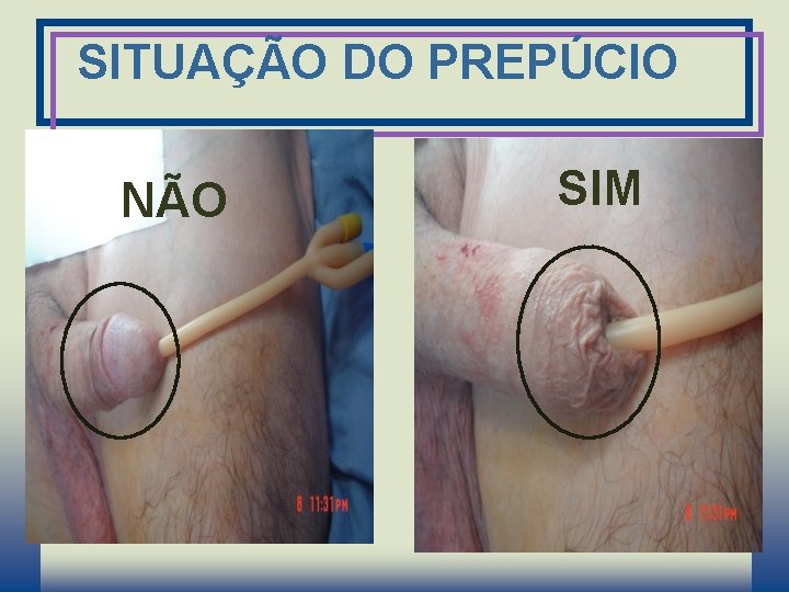 SITUAÇÃO DO PREPÚCIO NÃO SIM 