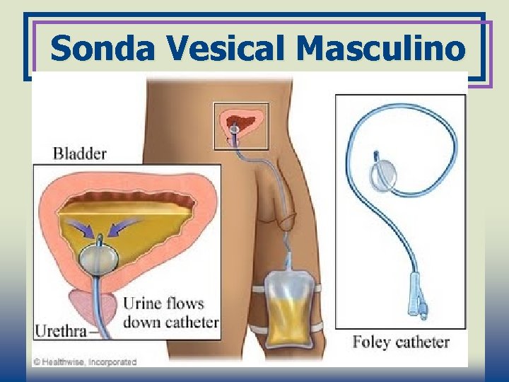 Sonda Vesical Masculino 