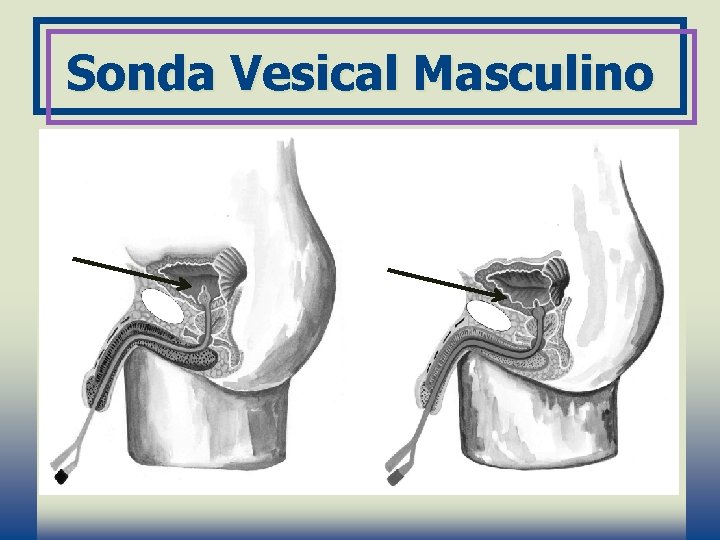 Sonda Vesical Masculino 