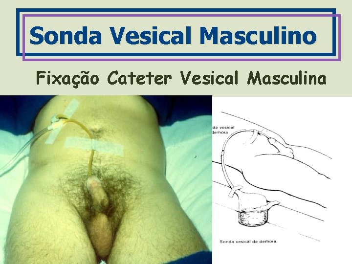 Sonda Vesical Masculino Fixação Cateter Vesical Masculina 