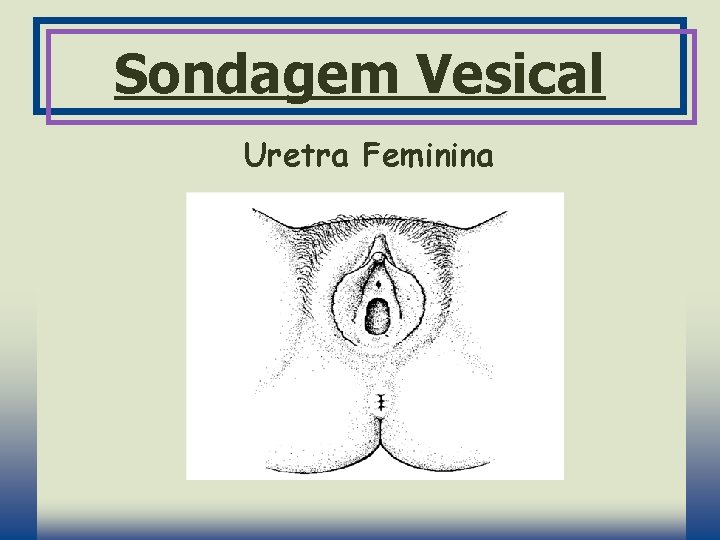 Sondagem Vesical Uretra Feminina 